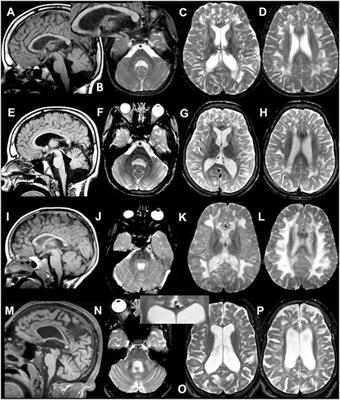 Specific MRI Abnormalities Reveal Severe Perrault Syndrome due to CLPP Defects